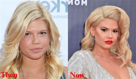 chanel west coast implants.